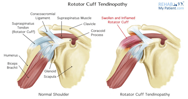 rotator_cuff_tendinopathy
